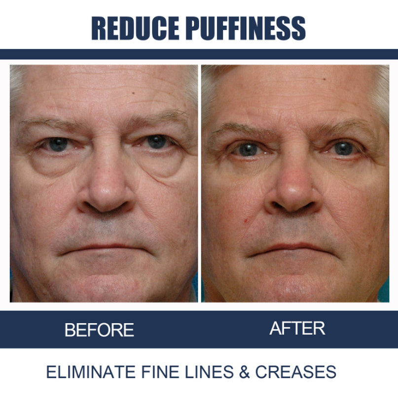 OPENEYES Awaken Lifting Eye Gel （1+1 Buy One Get One Free）